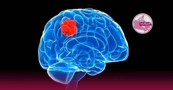 درمان تازه سرطان با فریب سلول های مغزی